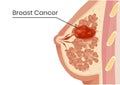 Breast cancer structure. Vector illustration of the lobular carcinoma