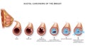 Breast carcinoma