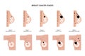 Breast disease concept