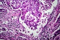 Breast ductal carcinoma, light micrograph Royalty Free Stock Photo