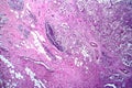 Breast ductal carcinoma, light micrograph Royalty Free Stock Photo