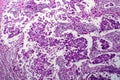 Breast ductal carcinoma, light micrograph Royalty Free Stock Photo
