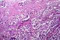 Breast ductal carcinoma, light micrograph Royalty Free Stock Photo