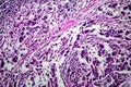 Breast ductal carcinoma, light micrograph Royalty Free Stock Photo