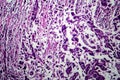 Breast ductal carcinoma, light micrograph Royalty Free Stock Photo