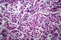 Breast ductal carcinoma, light micrograph Royalty Free Stock Photo