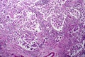 Breast ductal carcinoma, light micrograph Royalty Free Stock Photo