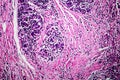 Breast ductal carcinoma, light micrograph Royalty Free Stock Photo