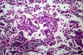 Breast ductal carcinoma, light micrograph Royalty Free Stock Photo