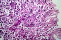 Breast ductal carcinoma, light micrograph Royalty Free Stock Photo