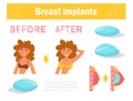 Before and after. Breast surgery. Implants Vector. Cartoon. Isolated art on white background. Royalty Free Stock Photo