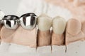 Bridged dental prostheses