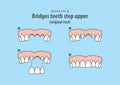 Bridges teeth step upper original root illustration vector on