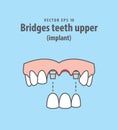 Bridges teeth upper implant illustration vector on blue backgr