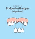 Bridges teeth upper original root illustration vector on blue