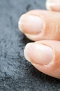Brittle damaged fingernails