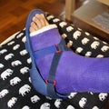 A broken ankle with purple plaster