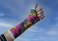Broken arm in cast but thumb up. Closeup midsection of a woman with broken arm in cast with sky background