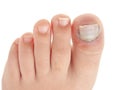 Broken big toe with nail detachment Royalty Free Stock Photo
