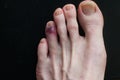 Broken toe showing bruising on skin due to injury Royalty Free Stock Photo