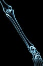 Broken bone under the x-rays Royalty Free Stock Photo