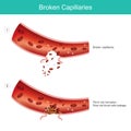 Broken capillaries.