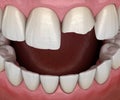 Broken central incisor tooth. Medically accurate 3D illustration of human teeth and dentures