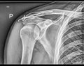 Broken clavicle bone fixation, Fracture repair