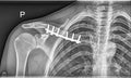 Broken clavicle bone, Shoulder Medical Xray Royalty Free Stock Photo