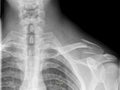 Broken clavicle Royalty Free Stock Photo