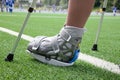 Broken foot, crutches - sports injury