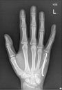 Broken Hand Medical Xray