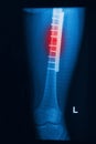 Broken human thigh x-rays image with implant Royalty Free Stock Photo