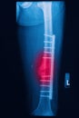 Broken human thigh x-rays image with implant Royalty Free Stock Photo