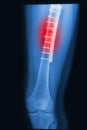 Broken human thigh x-rays image with implant Royalty Free Stock Photo