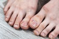 Broken and ingrown ugly toenails of a sloppy girl Royalty Free Stock Photo