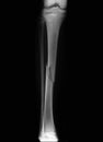 Broken leg (broken tibia) radiography Royalty Free Stock Photo