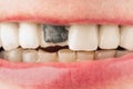 Broken metal-ceramic front tooth in female mouth Royalty Free Stock Photo