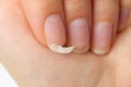 broken nail on a female hand. close-up shoot of broken nail. brittle fingernail Royalty Free Stock Photo