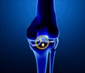 Broken posterior cruciate ligament. Injury and rupture. Anatomy Royalty Free Stock Photo