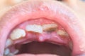 Close up tooth loss in children