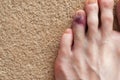 Broken toe showing bruising on skin due to injury Royalty Free Stock Photo