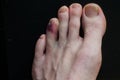 Broken toe showing bruising on skin due to injury Royalty Free Stock Photo