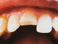 Broken tooth. Broken upper incisor in a man mouth