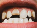 Broken tooth. Broken upper incisor in a man mouth Royalty Free Stock Photo