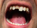 Broken tooth. Broken upper incisor in a man mouth. Royalty Free Stock Photo