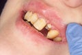 Broken tooth closeup. Girl at the dental reception