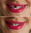 Broken tooth and Dental implant before and after