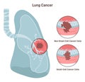 Bronchial cancer. Pathological malignant cells or tumor located