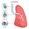 Bronchial cancer. Pathological malignant cells or tumor located